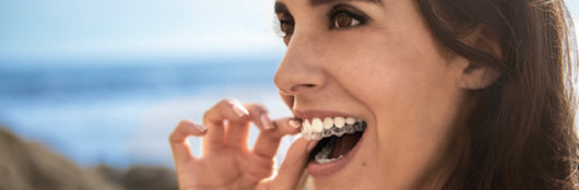 beugel onzichtbaar met invisalign